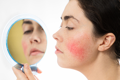 women-with-rosacea