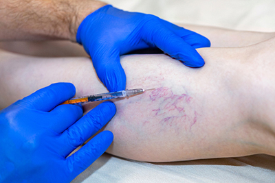 Spider-Vein-Injection-Treatment